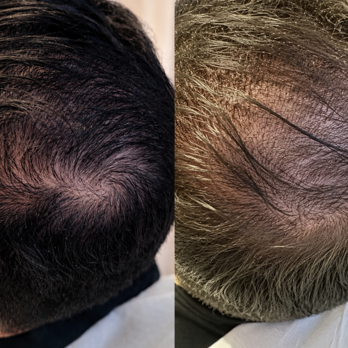 mesotherapie_capillaire